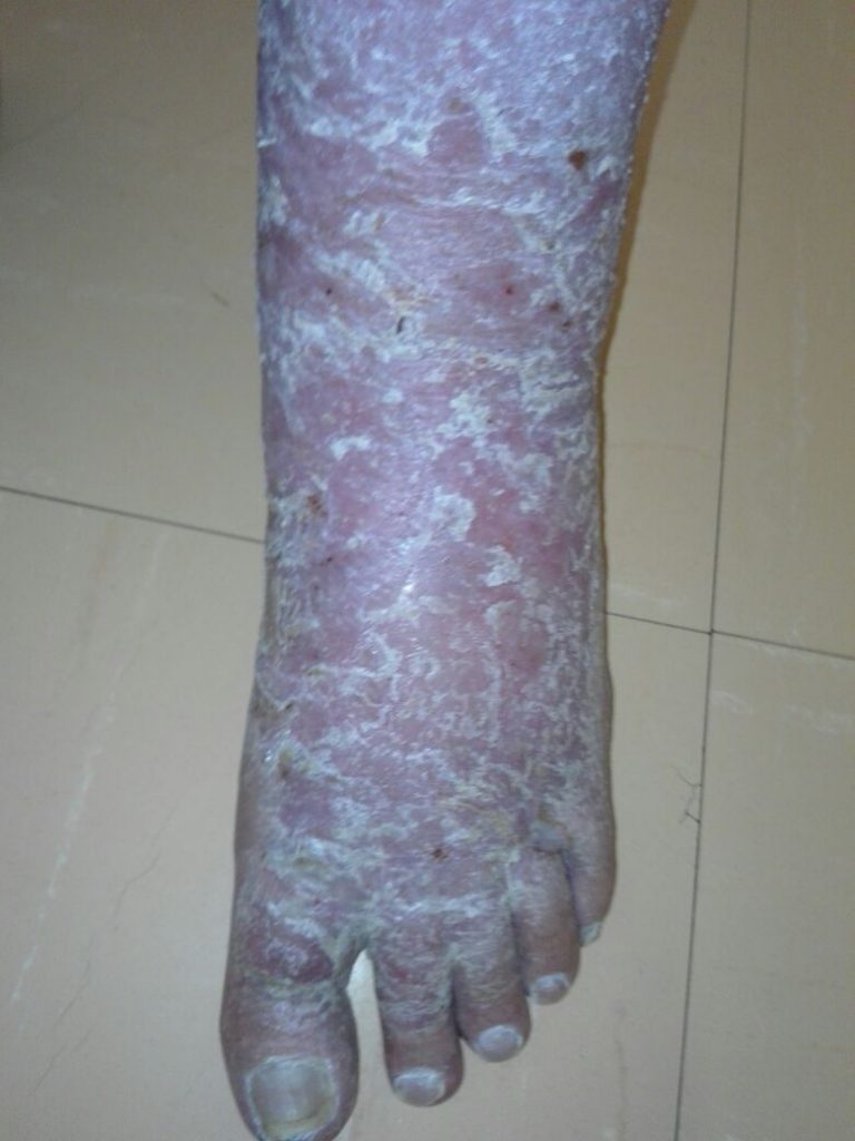 Skin wounds: "Incurable" venous leg ulcers heal in 9 weeks - A Medical