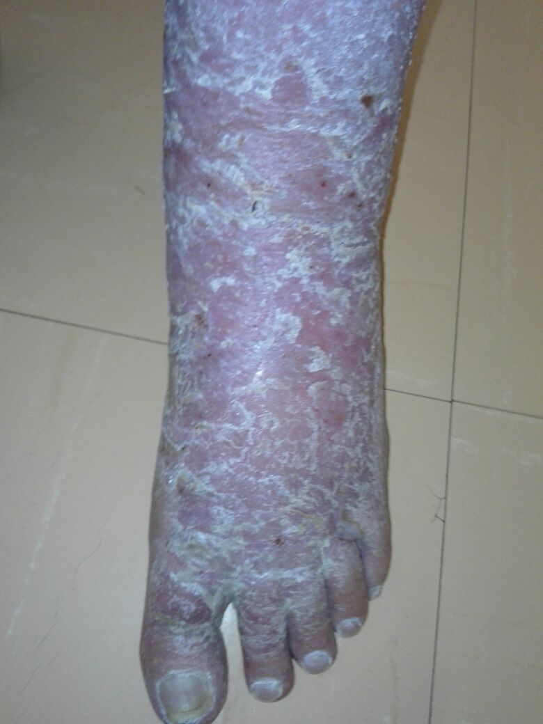 IMG-20171110-WA0001 wheatgrass heals venous ulcers