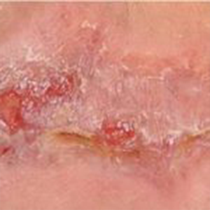 Diabetic Foot Ulcer After 7 Days Fig. 2. Seven days after wheatgrass extract first applied. A remarkable response.