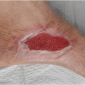 The diabetic foot ulcer prior to commencement of wheatgrass extract.