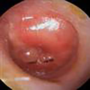 bullous myriingitis - a cause of earache