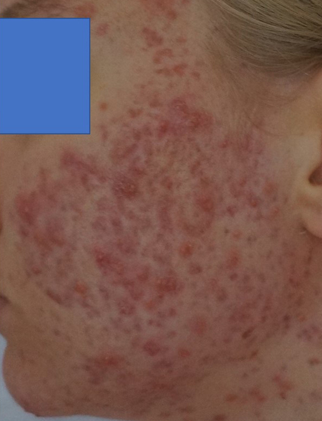 severe acne pre wheatgrass extract