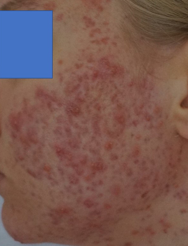 1 severe acne pre wheatgrass extract