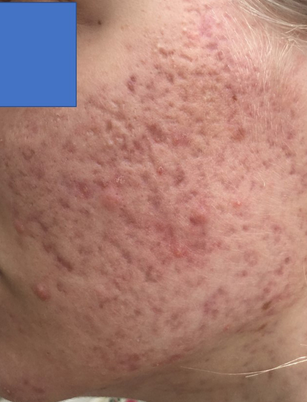 2 significant improvement of severe acne after 6 months wheatgrass extract treatment