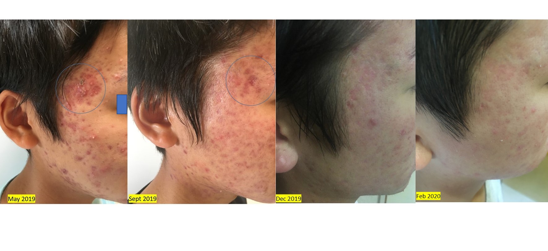 Severe acne - Marked improvement after 9 months' wheatgrass extract treatment Severe childhood acne unresponsive to "standard" medical treatments shows significant improvement after 9 months' wheatgrass extract application.