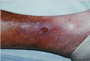 Fig. 3. The patient's venous ulcer one day after first wheatgrass extract application. Note that the crust (scab) has completely disappeared.