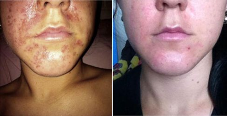 Before_and_after_wheatgrass_allergy_burn Rapid relief of fruit acid peel allergic reaction