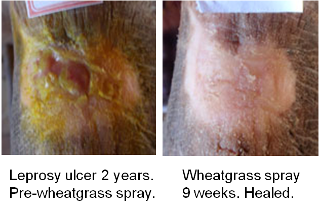 Before & After Wheatgrass Leprosy wheatgrass extract heals leprosy ulcer