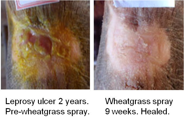 wheatgrass extract heals leprosy ulcer