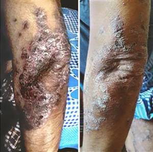 Fig. 6. Severe, chronic psoriasis, unresponsive to orthodox medical treatment exhibits remarkable recovery just two weeks after commencement of wheatgrass extract application.