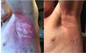 RADIATION BURNS BEFORE & AFTER