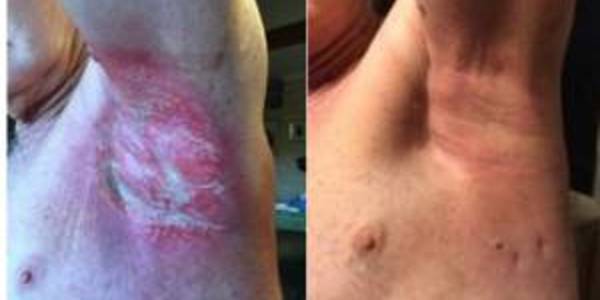 Figure 2. The patient has suffered severe, deep radiation burns that would normally take several weeks or even months to heal. Instead, ligands in wheatgrass extract have re-connected dysfunctional cellular receptors to the brain, enabling it to heal his damaged skin. Note also the absence of inflammation in the picture on the right (the patient is also pain-free), and recovery of the burn wounds, just 2 weeks after the injury.