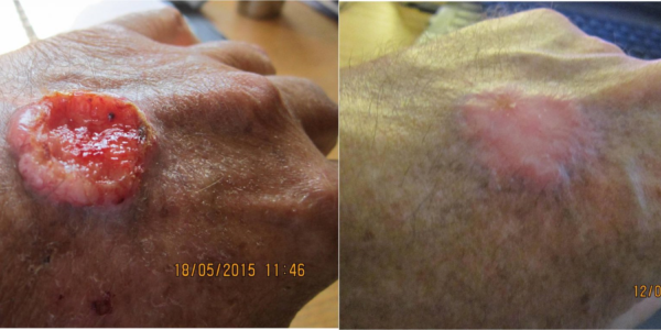Spider bite causes open wound for 9 years. Healed by wheatgrass extract in 7 months.