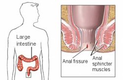 Fig. 1. Anal fissure is a split in the anal wall that may or may not be painful. 
