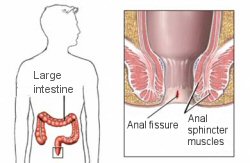anal_fissure Fig. 1. Anal fissure is a split in the anal wall that may or may not be painful.