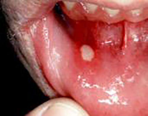 apthous_ulcer An inflamed, and undoubtedly very painful aphthous (mouth) ulcer