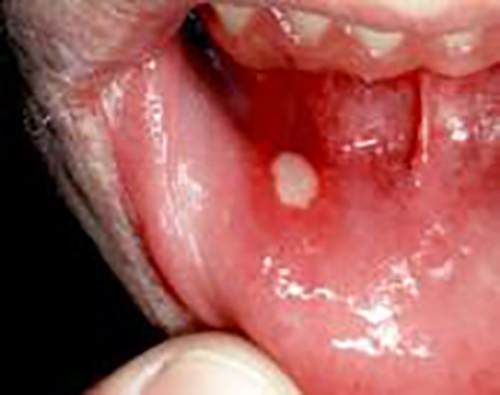 An inflamed, and undoubtedly very painful aphthous (mouth) ulcer