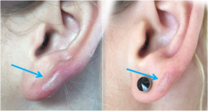 burn-on-ear-by-hair-straightening-iron Figs. 1&2. Wheatgrass extract relieves first-degree burn pain allowing ear stud re-insertion several minutes later, while in the photo below, the patient's severe radiotheray burns have recovered in just ten days.