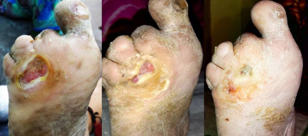 Fig. 4.  'Unhealable' leprosy wound present 15 years in 60 year old female heals after 4 once a monthly applications of wheatgrass extract.  (View 6 more cases)