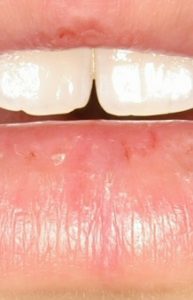 lower-lip-aft-193x300 wheatgrass heals split lip