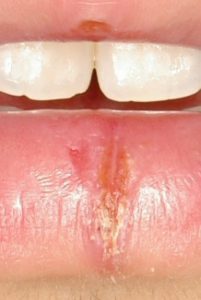 lower-lip-bef-201x300 Split lip one year. Numerous treatments failed.