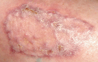 skingraft_leg20days Fig. 4. The graft has completely healed in 3 weeks.