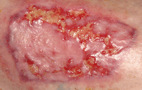 skingraft_leg_2days Fig. 3. Two days later, healthy appearance has returned due to restoration of blood supply to the area.