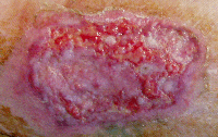 skingraft_leg_preWG Fig. 2. Skin graft before wheatgrass