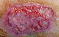 Fig. 2. Skin graft before wheatgrass