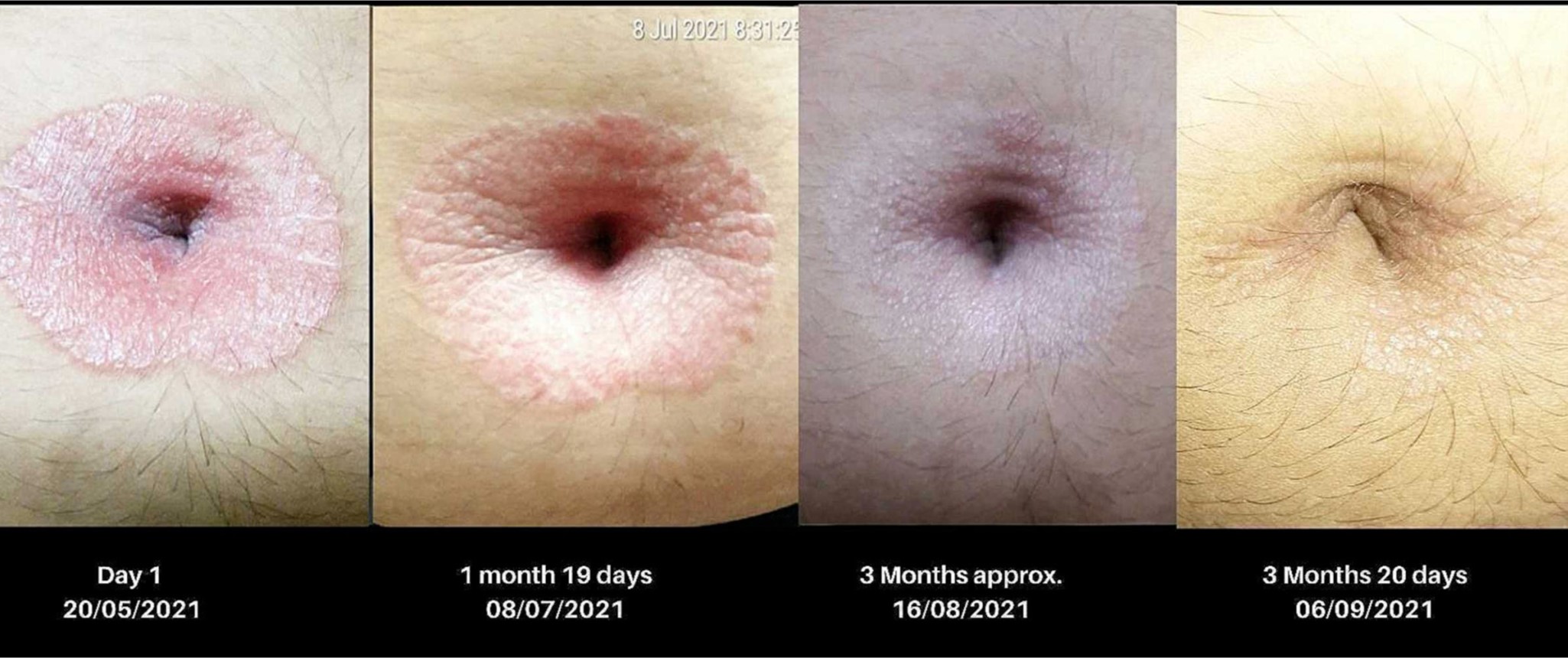 unbilical psoriasis 17 y.o. Fig. 7. Peri-umbilical psoriasis in a 17-year-old female, present 2 years. Unresponsive to topical steroids and numerous other treatments. Healed by wheatgrass extract in 4 months with once weekly application.