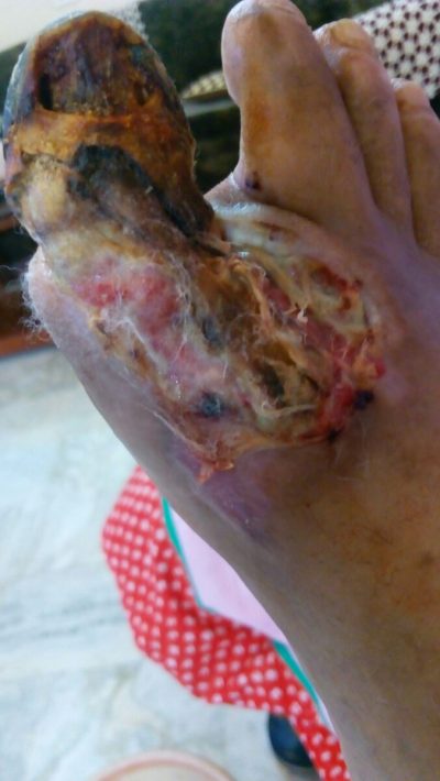 Skin: Gangrene & amputation of foot avoided - A Medical Doctor's Guide