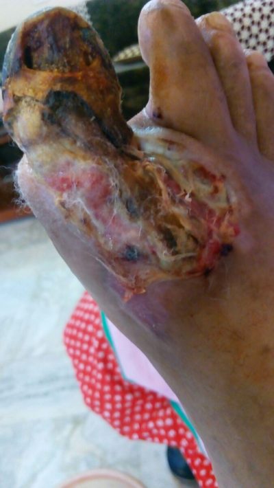 Gangrene - amputation of foot avoided by wheatgrass extract - A Medical