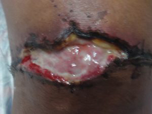 1 2 weeks' wound infection - note pus. Wheatgrass extract applied.