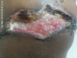 2 weeks later, wound dry & beginning to heal. No infection.