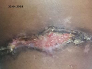 3 At 5 weeks, wound is clean & healing well.