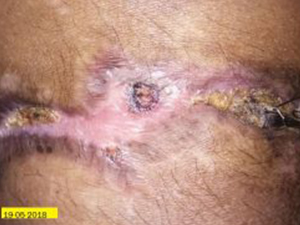 4 At 2 months, wound is completely healed.