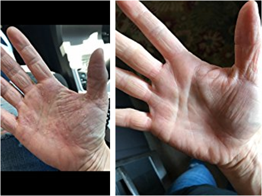 Before and after healing of topical steroid damaged hand with Dr Wheatgrass Skin Recovery Spray