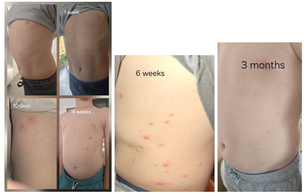 Molluscum treatment before and after Dr Wheatgrass spray