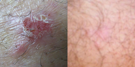 Non-healing skin lesion 5 years. Healed in 4 weeks with wheatgrass extract.