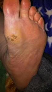 foot ulcer healed