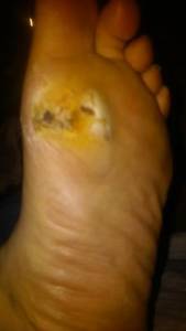 foot ulcer