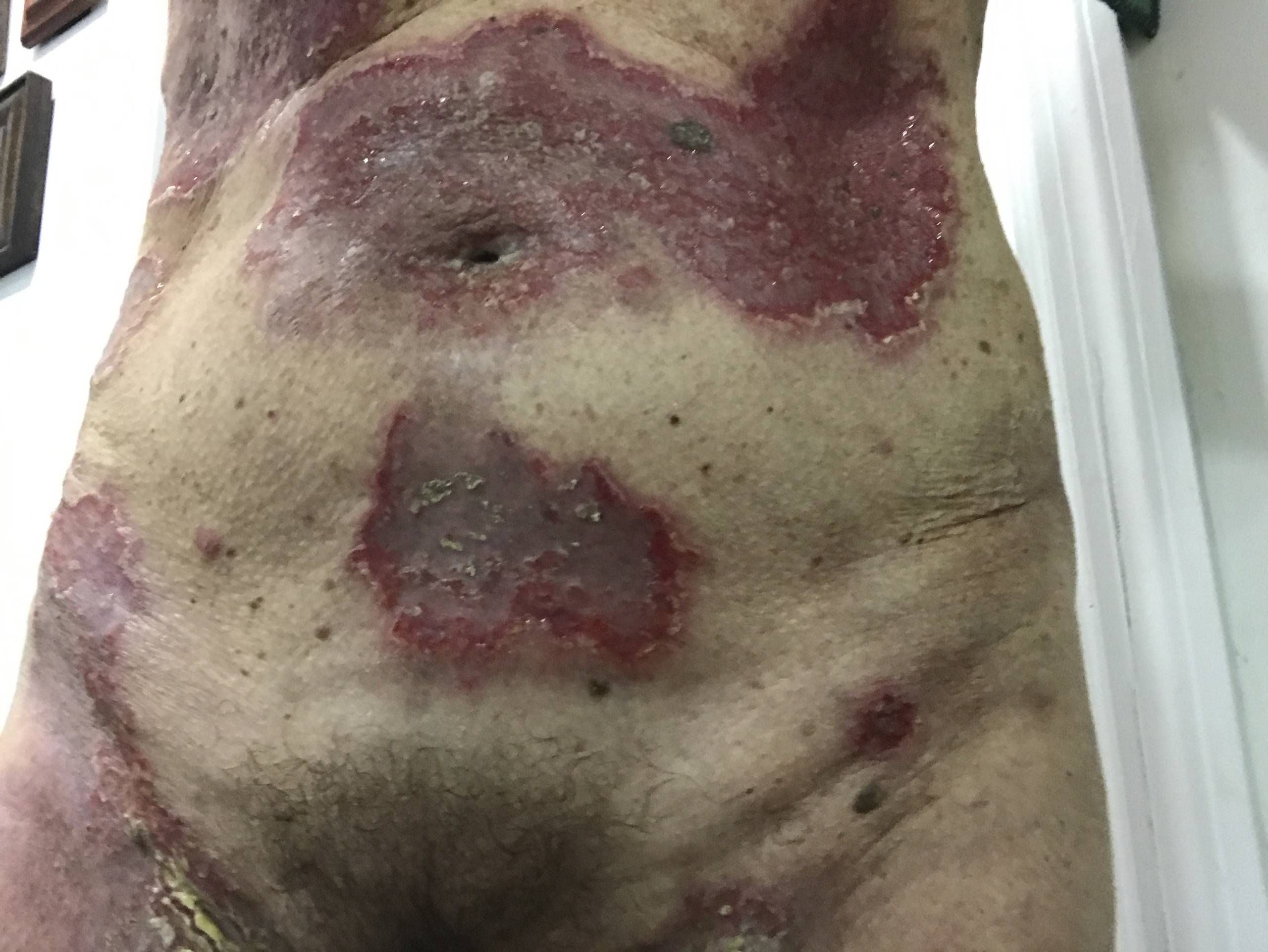 20170419 Hailey Hailey disease