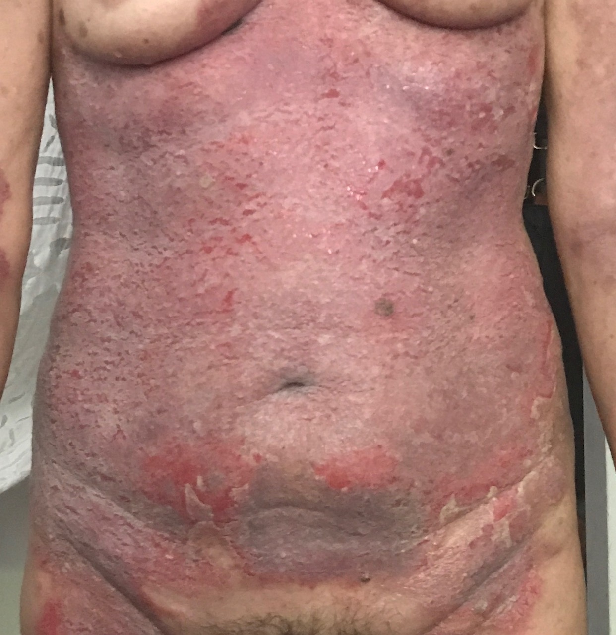 20170510_abdo Hailey Hailey disease