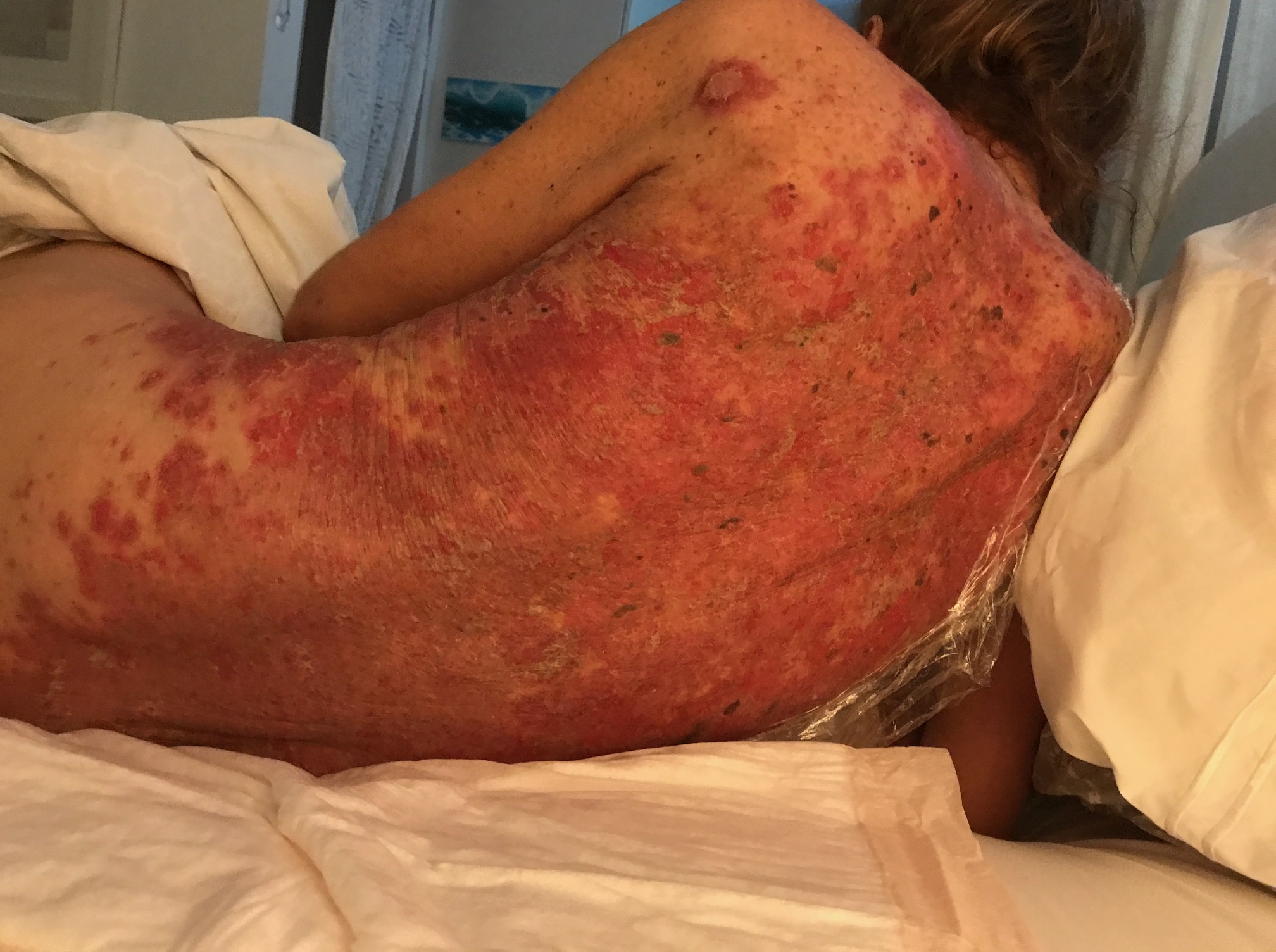 20170605_back Hailey Hailey disease