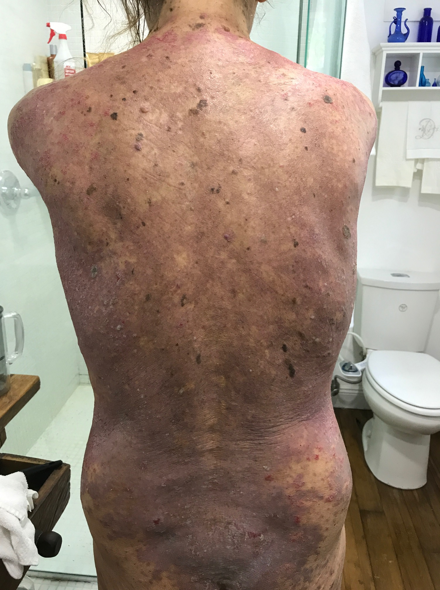 20170615 back Hailey Hailey disease