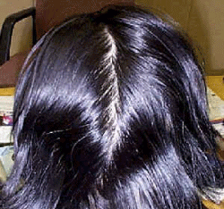 Alopecia areata (hair loss). 3 Cases - A Medical Doctor's Guide to  Wheatgrass Healing