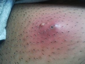 abscess-pointing-300x225 Fig. 1. An abscess ready to be incised and drained