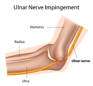 Fig. 1. Reflex sympathetic dystrophy. Red circle shows where the ulnar nerve was entrapped at the elbow.