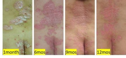 wheatgrass significantly improves psoriasis rash