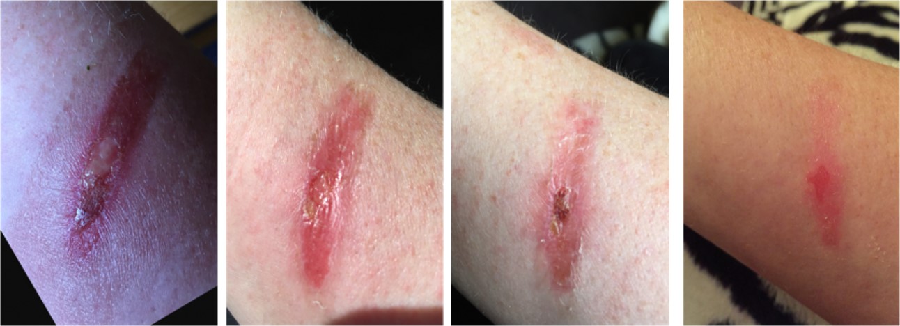 2nd-degree-burn 2nd-degree-burn